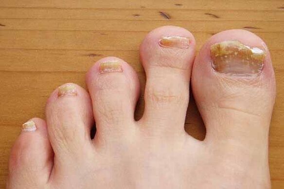 Aspecto de las uñas de los pies afectadas por hongos. 