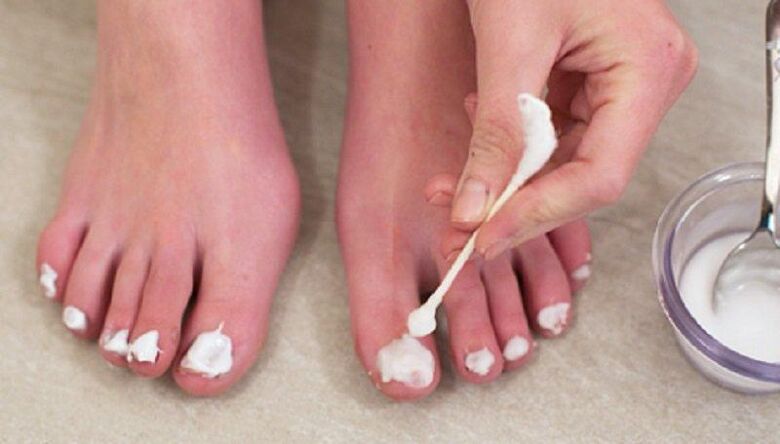 Tratamiento tradicional para los hongos en las uñas de los pies. 