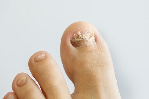 Hongo de uñas
