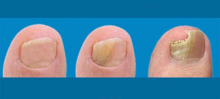 Proceso de desarrollo de hongos de uñas
