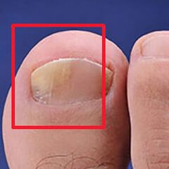 Micosis o hongo de uñas