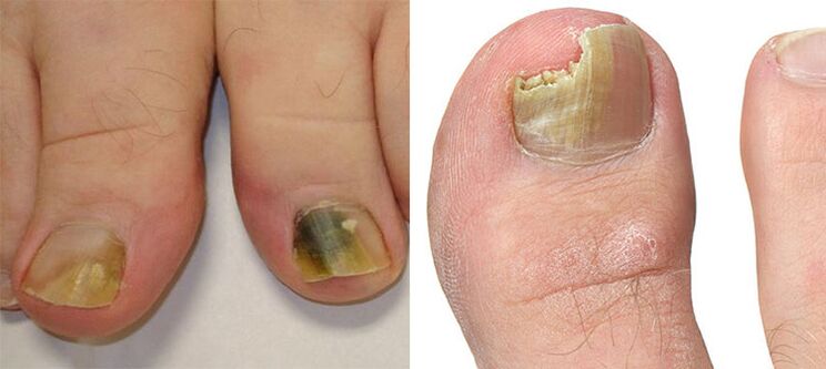 Onicomicosis destrucción de uñas con un hongo