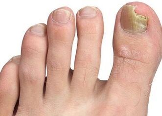 Síntomas del hongo de las uñas