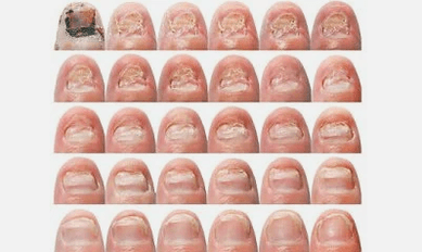 ¿Cómo se ve el hongo de uñas