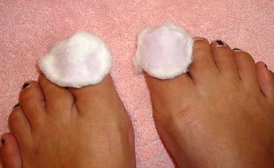 compresa para el tratamiento de hongos en las uñas de los pies