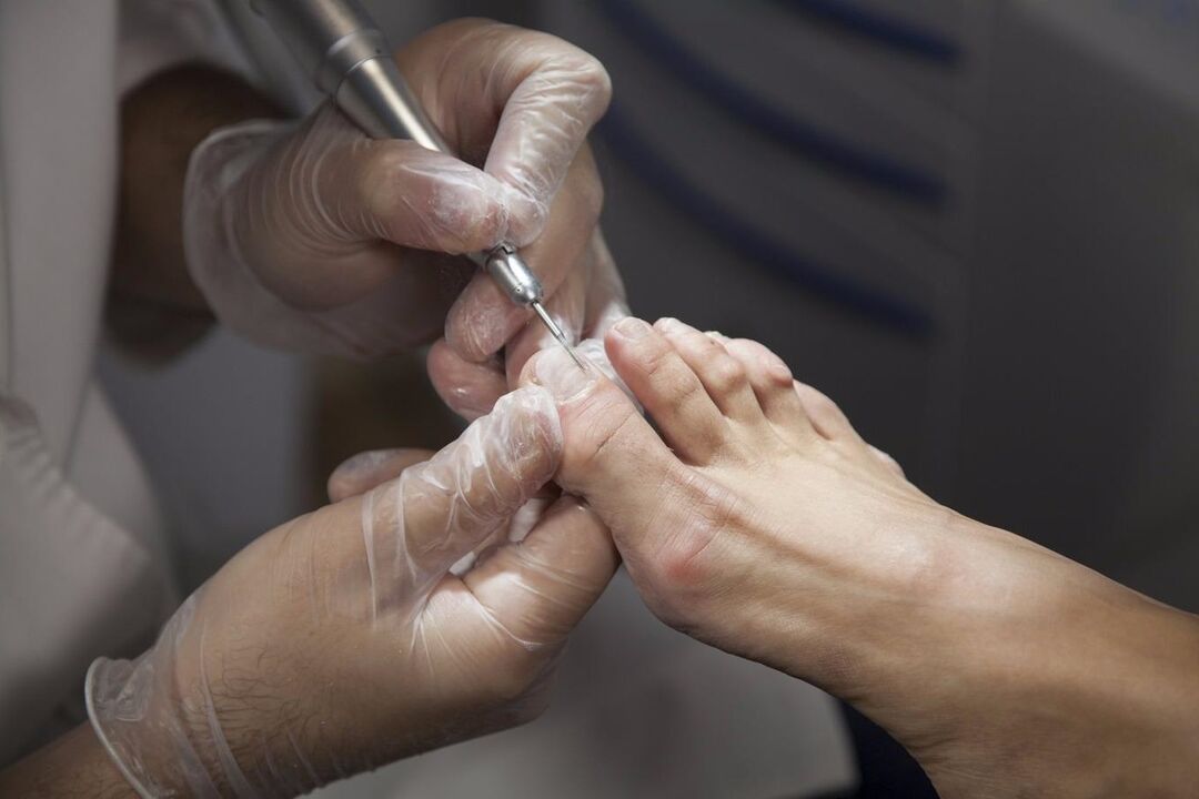 tratamiento profesional para hongos en las uñas de los pies