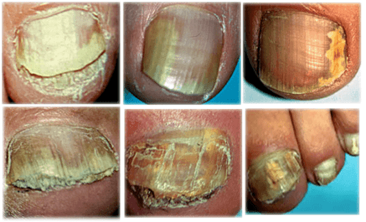 tipos y formas de hongos en las uñas de los pies