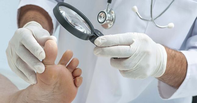 El médico le recetará un remedio para los hongos en las uñas de los pies después de diagnosticar la enfermedad. 