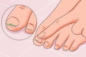 infección por hongos en las uñas