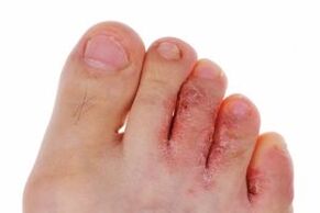 infección por hongos en los dedos de los pies