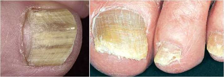 hongos en las uñas de los pies