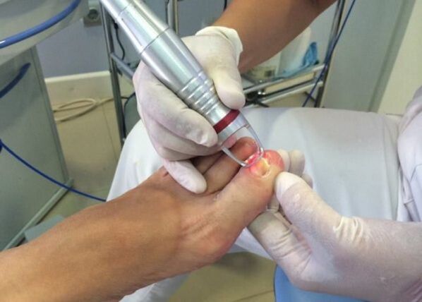 Tratamiento con láser para hongos en las uñas del dedo gordo del pie