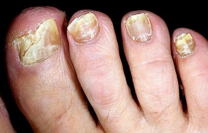 Hongos avanzados en las uñas de los pies que requieren un tratamiento complejo