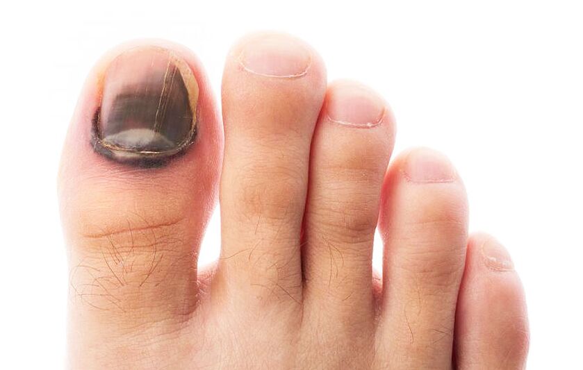 Infección por hongos en la placa ungueal del dedo del pie. 